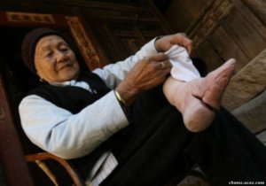 Chinese-Foot-Binding-Toes-Almost-Fused-670x469